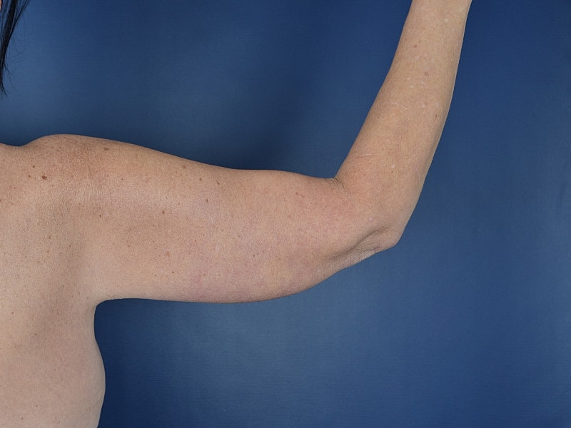 Arm Lift Before & After