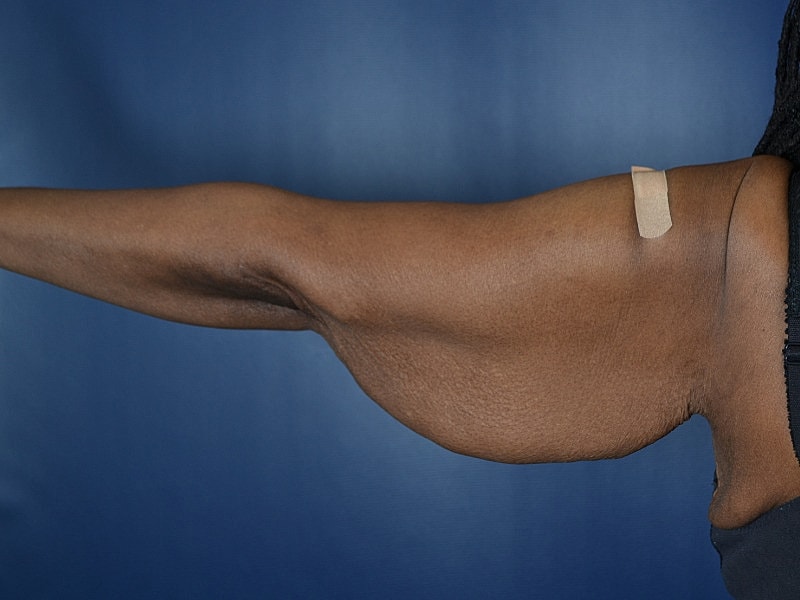 Arm Lift Before & After