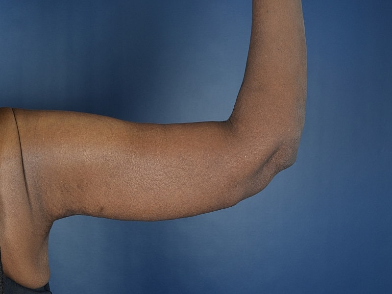 Arm Lift Before & After