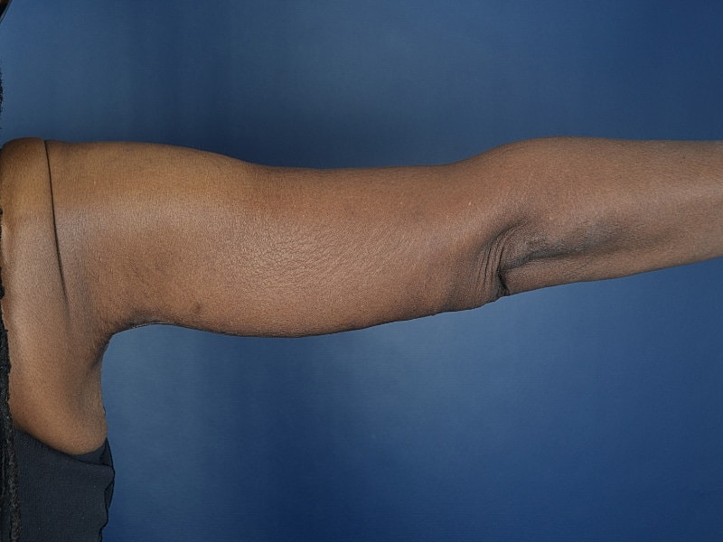 Arm Lift Before & After