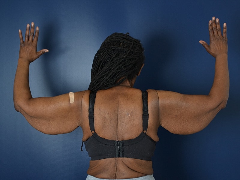 Arm Lift Before & After