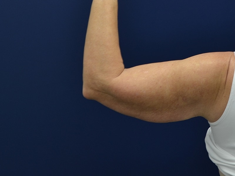 Arm Lift Before & After