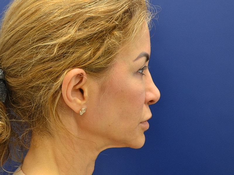 Neck Lift Before & After