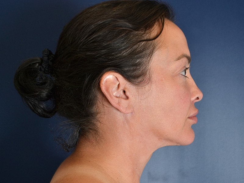 Neck Lift Before & After