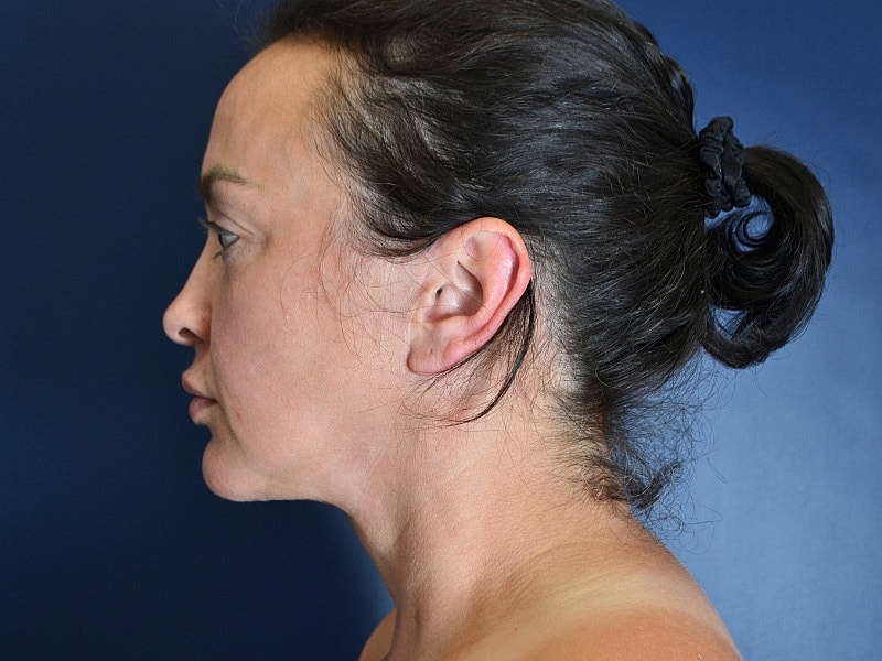 Neck Lift Before & After
