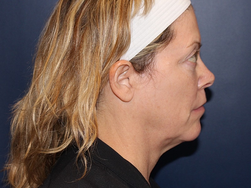 Neck Lift Before & After