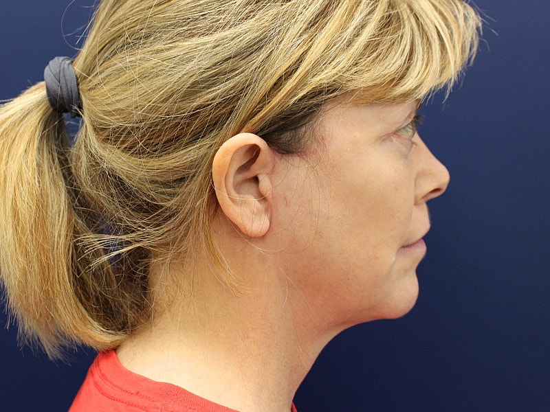 Neck Lift Before & After