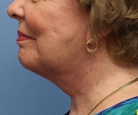 Neck Lift Before & After