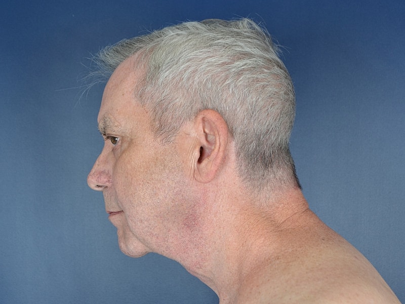 Neck Lift Before & After