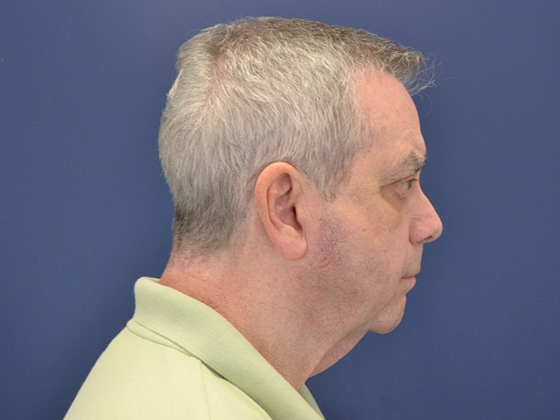 Neck Lift Before & After