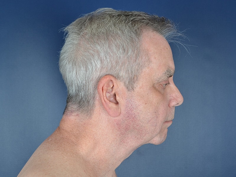 Neck Lift Before & After