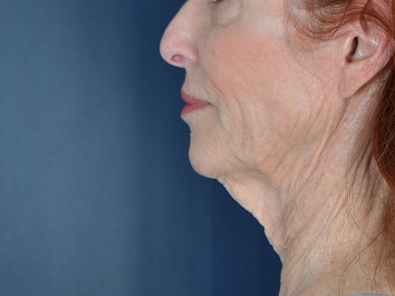 Neck Lift Before & After