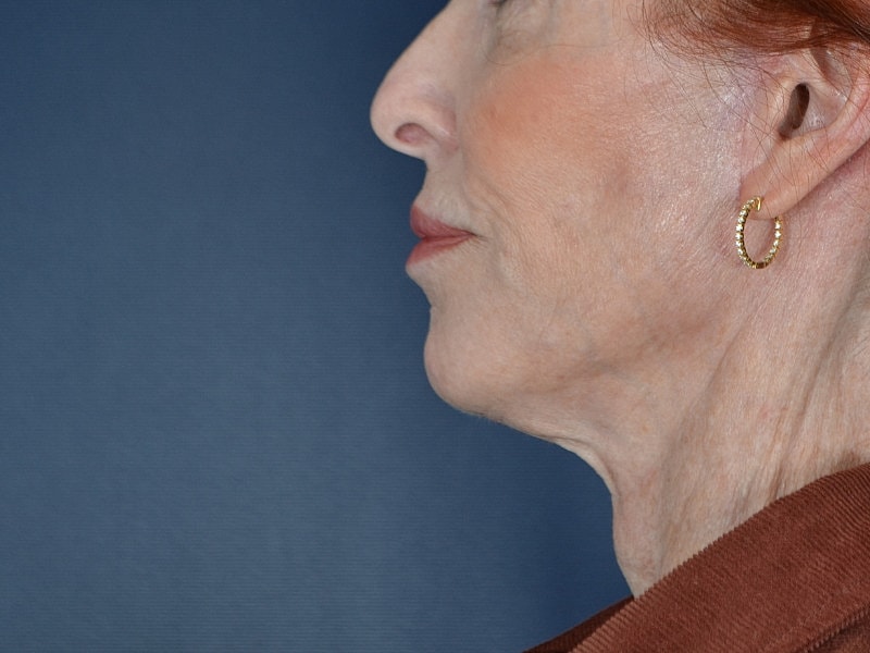 Neck Lift Before & After