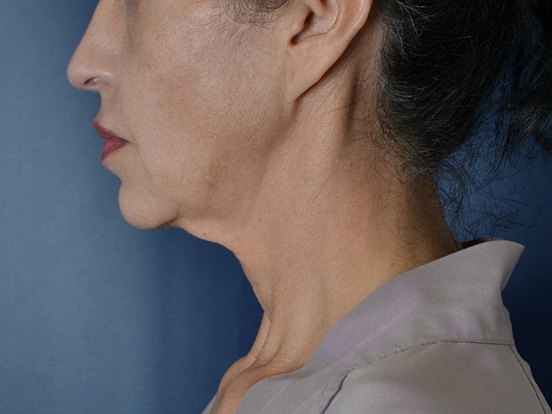 Neck Lift Before & After