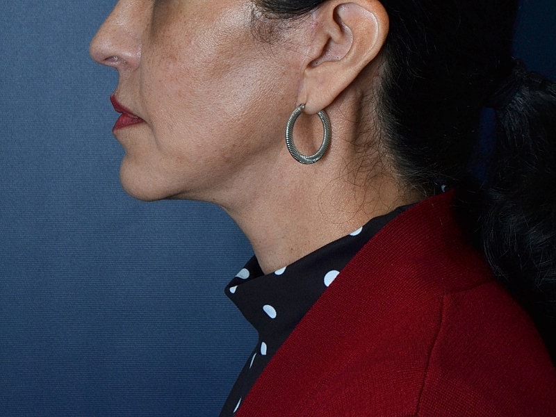 Neck Lift Before & After