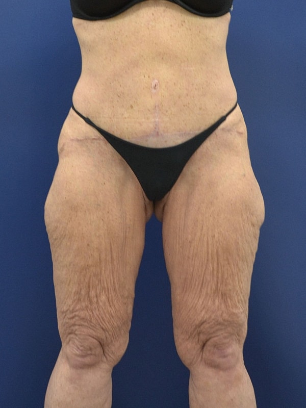 Lower Body Lift Before & After