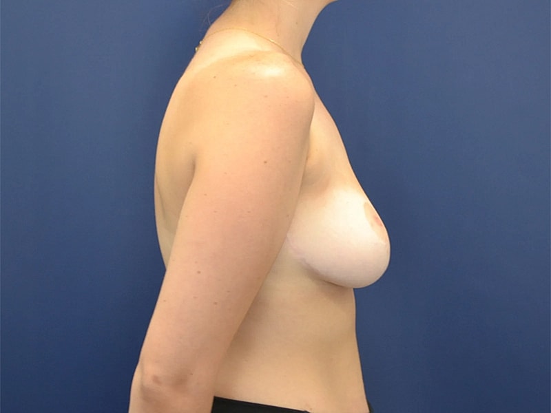 Breast Reduction Before & After