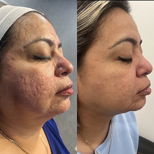 Microneedling Before & After