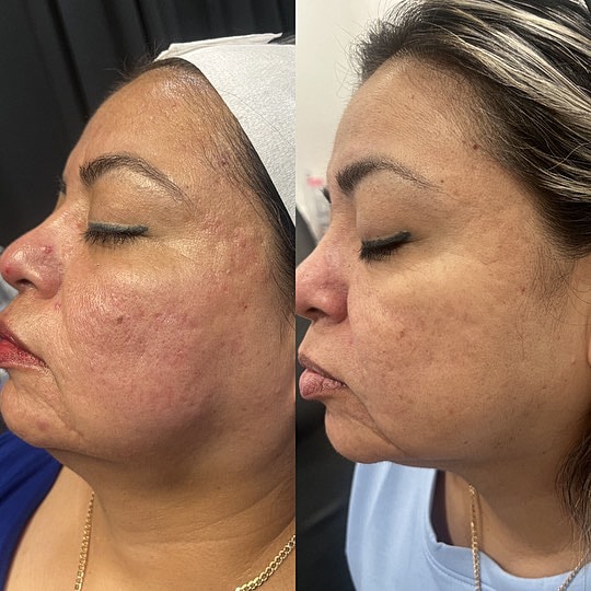 Microneedling Before & After