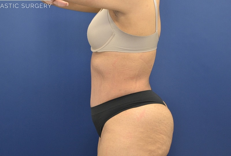 Mommy Makeover Before & After