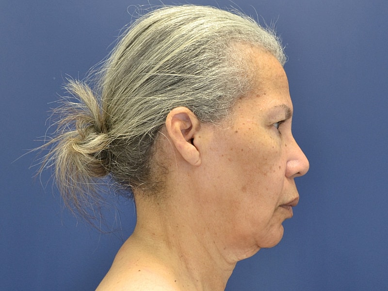 Facelift Before & After