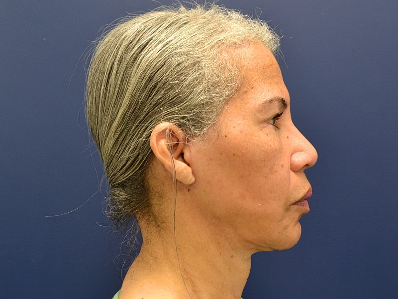 Facelift Before & After