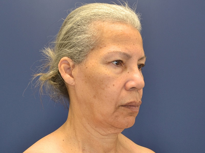 Facelift Before & After