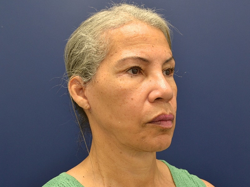 Facelift Before & After