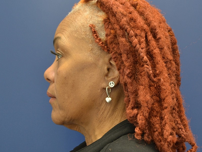 Facelift Before & After