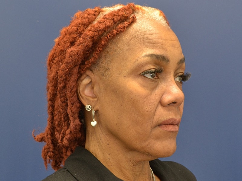 Facelift Before & After