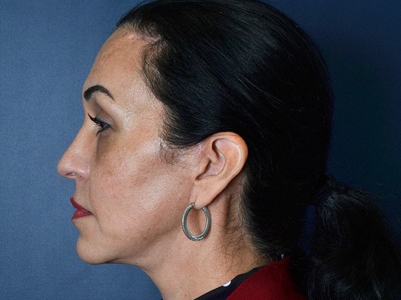 Facelift Before & After