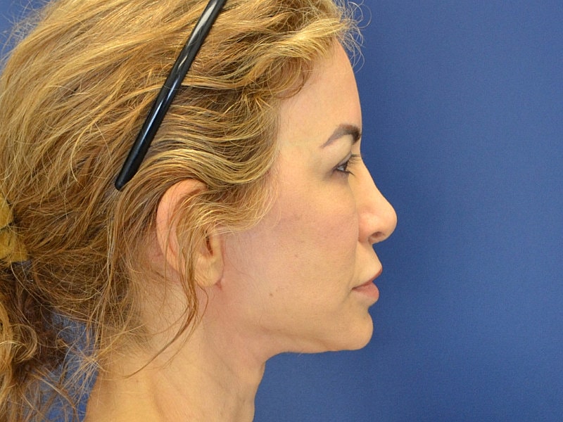 Facelift Before & After