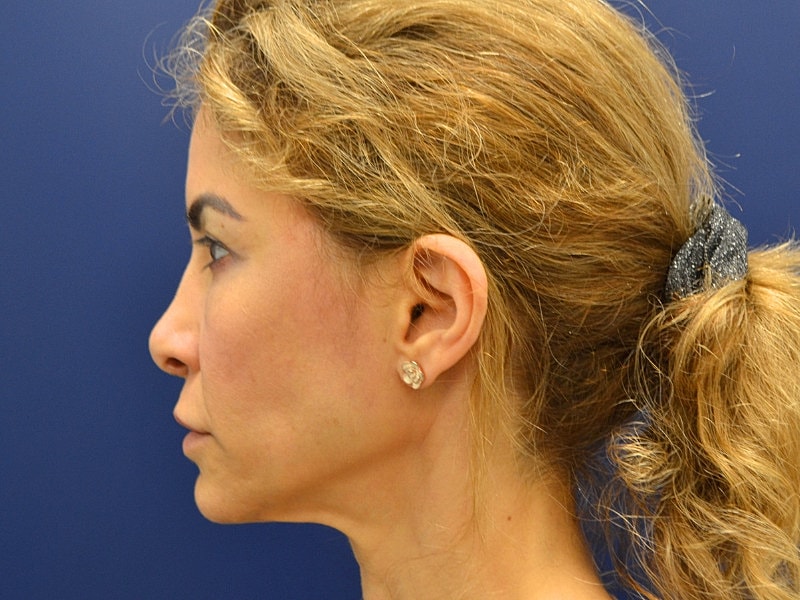 Facelift Before & After