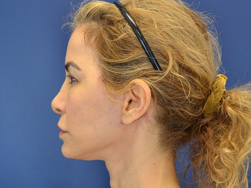 Facelift Before & After