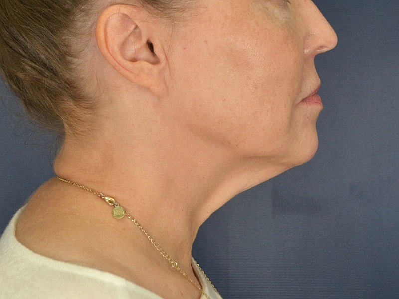 Facelift Before & After