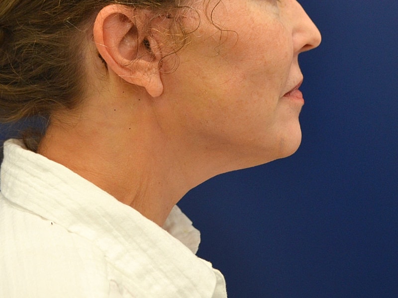 Facelift Before & After
