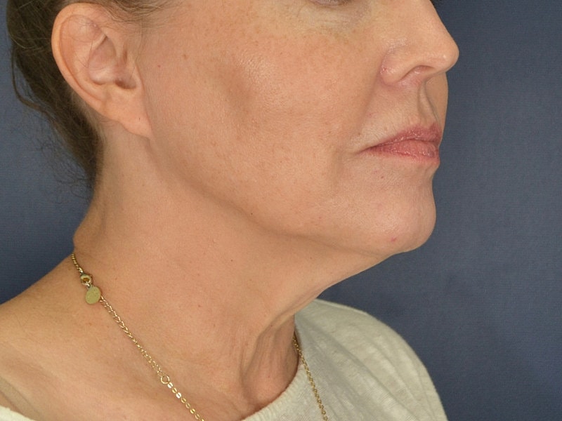Facelift Before & After