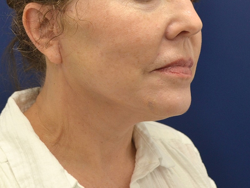 Facelift Before & After