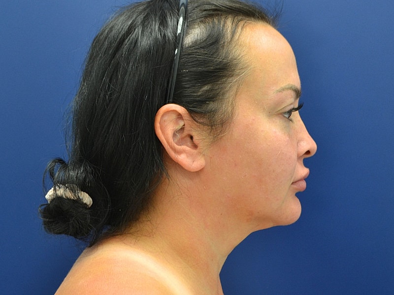 Facelift Before & After