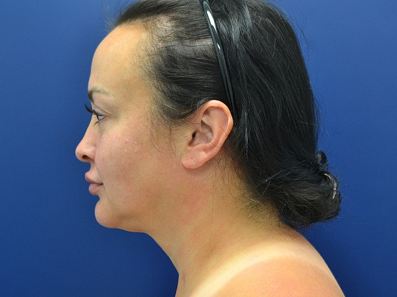 Facelift Before & After