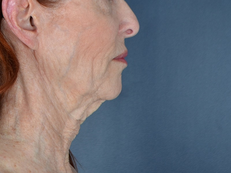 Facelift Before & After