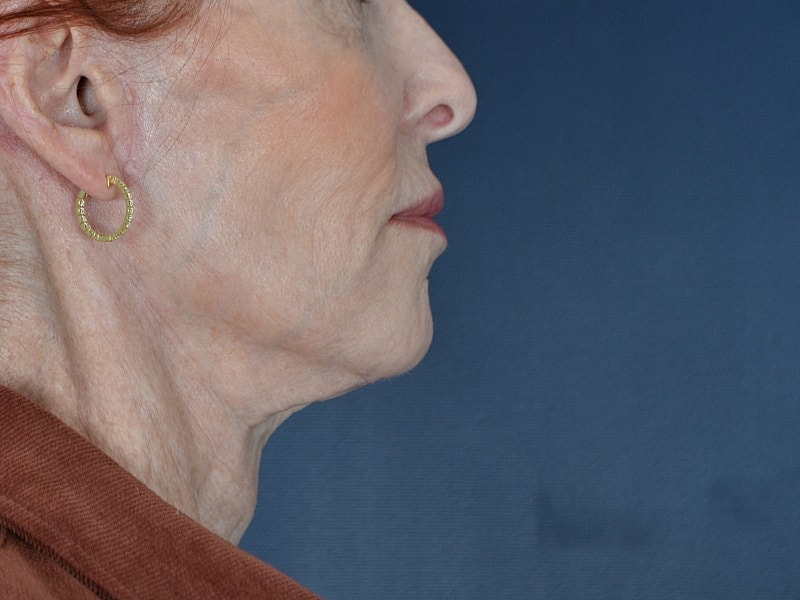 Facelift Before & After