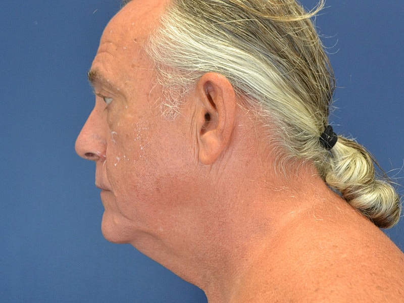 Facelift Before & After