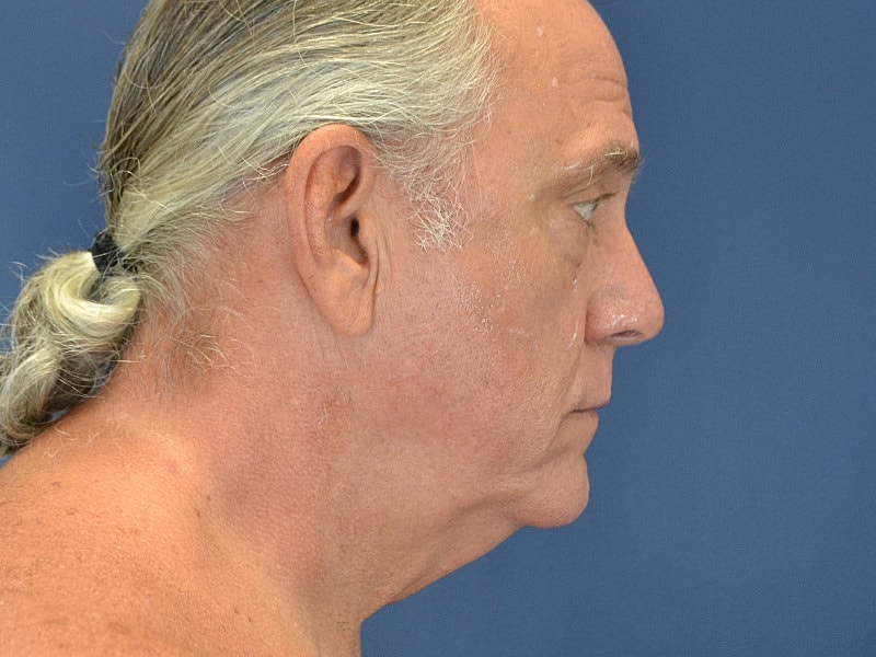 Facelift Before & After