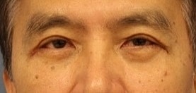 Eyelid Surgery Before & After