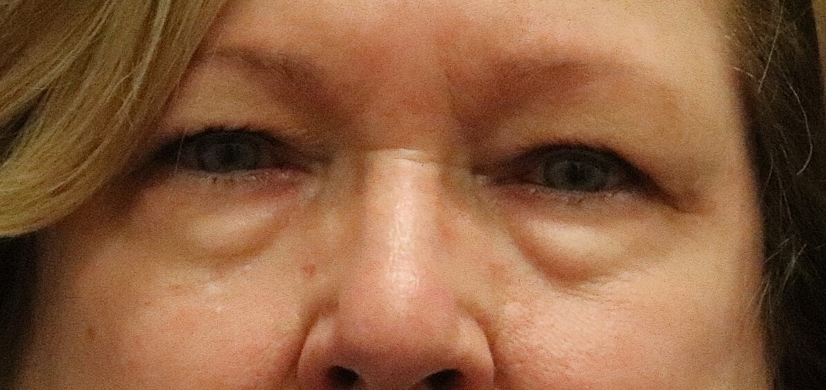 Eyelid Surgery Before & After