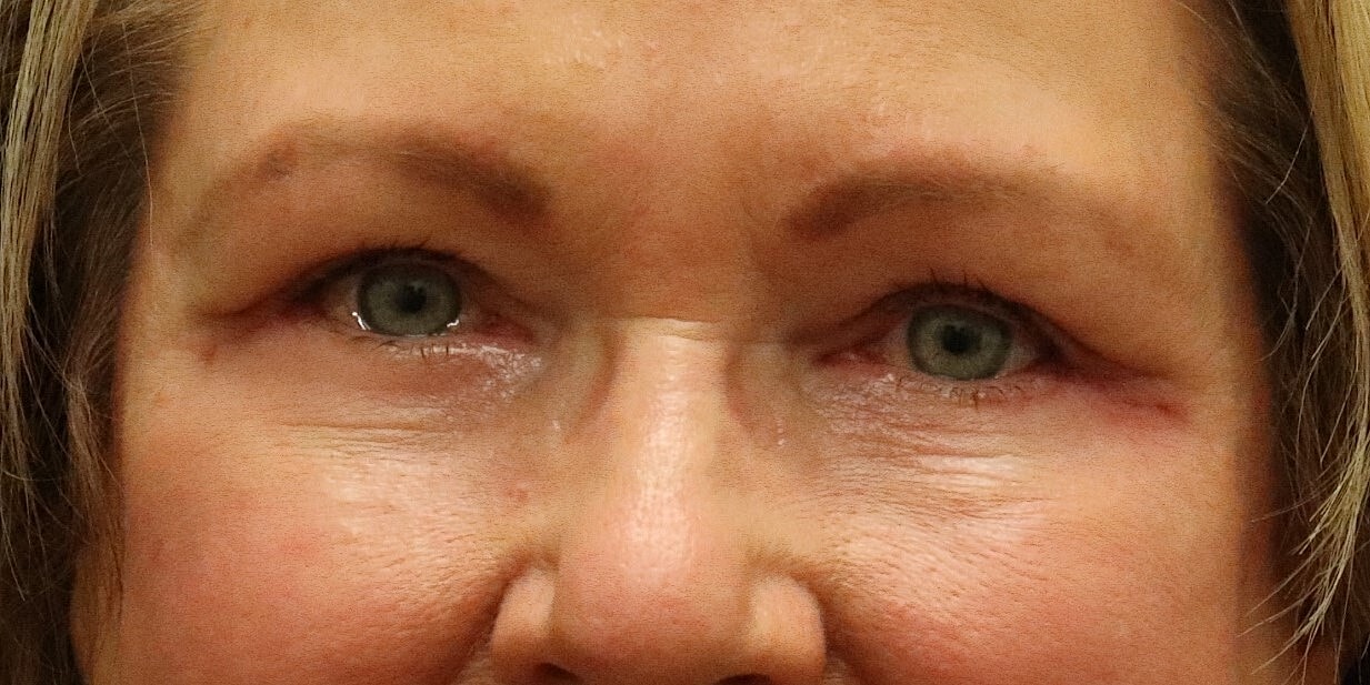 Eyelid Surgery Before & After