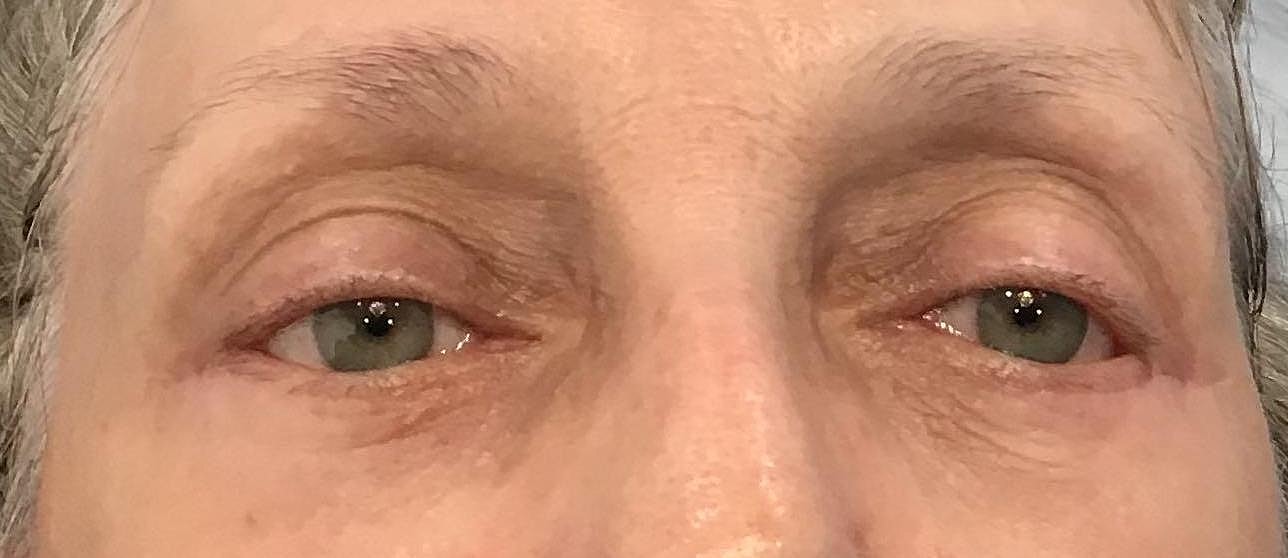 Eyelid Surgery Before & After