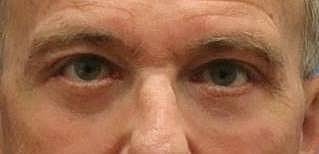 Eyelid Surgery Before & After