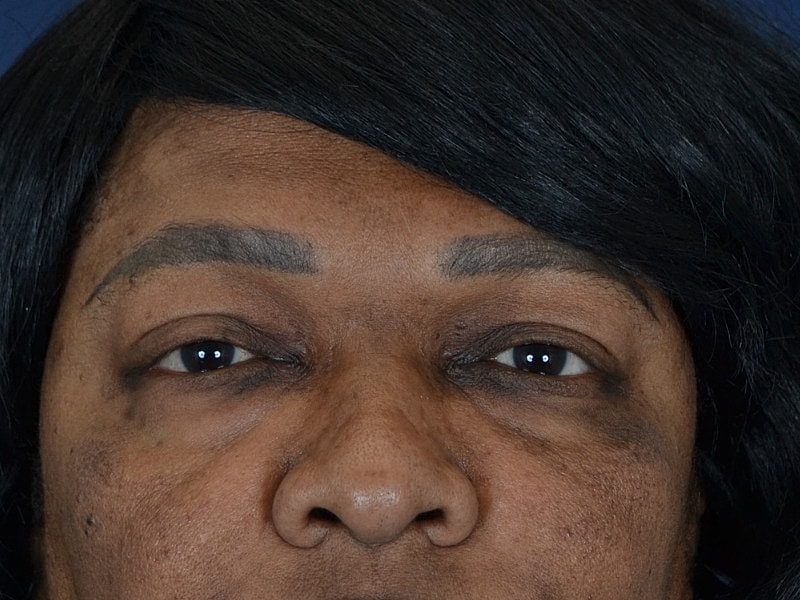 Eyelid Surgery Before & After